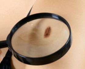 Molecule may hold key to melanoma progression. Molecule may hold key to melanoma progression