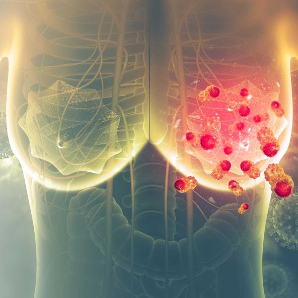 Researchers find breast cancer protein that could predict chemotherapy sensitivity. Researchers reveal breast cancer protein could predict chemotherapy sensitivity