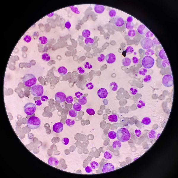 acute myeloid leukaemia 