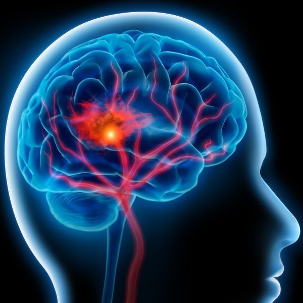 Stroke Recovery and Post-stroke Fatigue