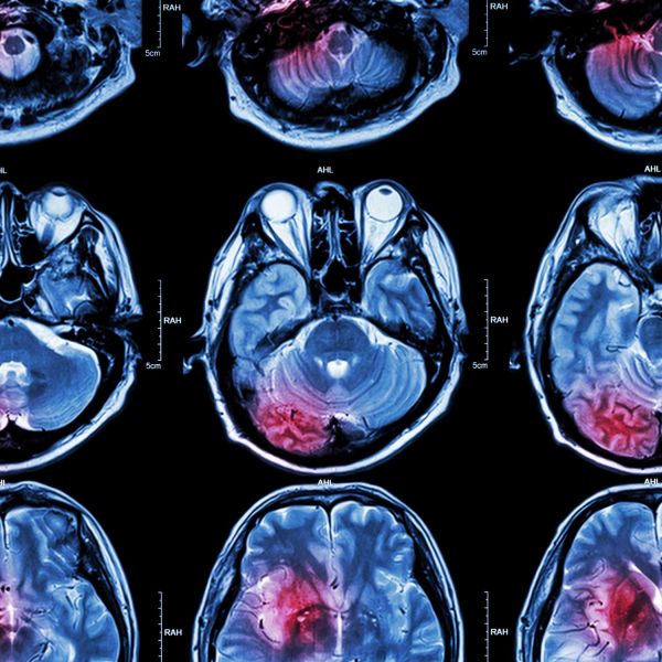 Great minds tackle brain cancer puzzle at International Summit