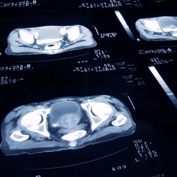 prostate cancer study. Ten year prostate cancer trial proves optimal treatment duration 