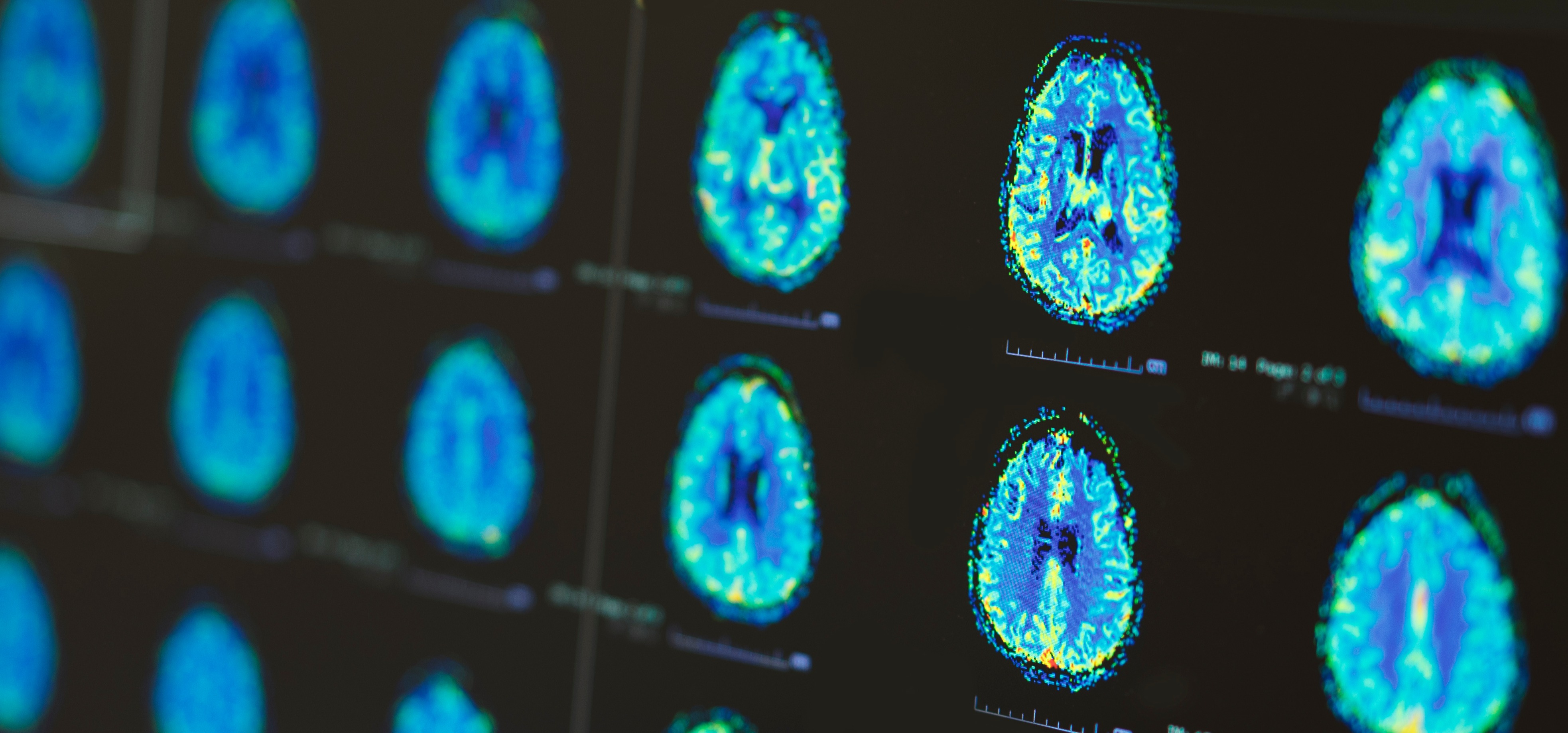 Buying time for stroke patients