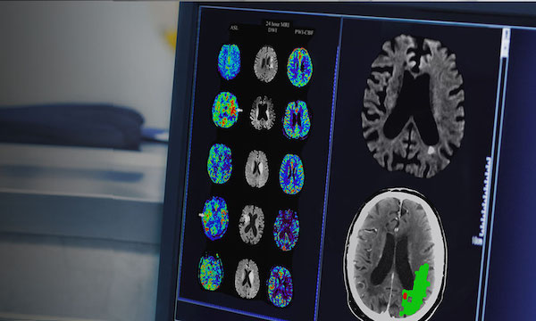 MRI images of a brain