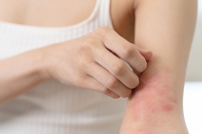 Woman itching her arm with a red rash from allergy symptom.
