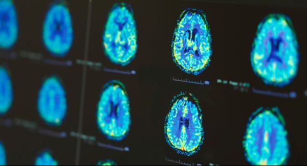 Buying time for more stroke patients