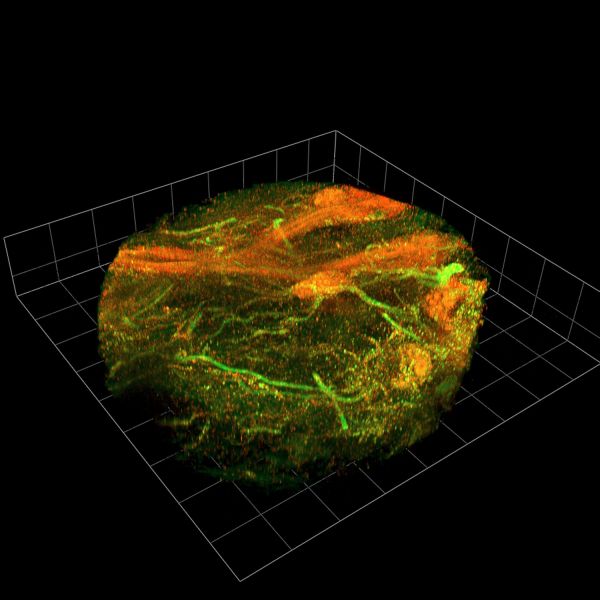 3D image of a breast cancer biopsy. Virtual cells provide new cancer insights