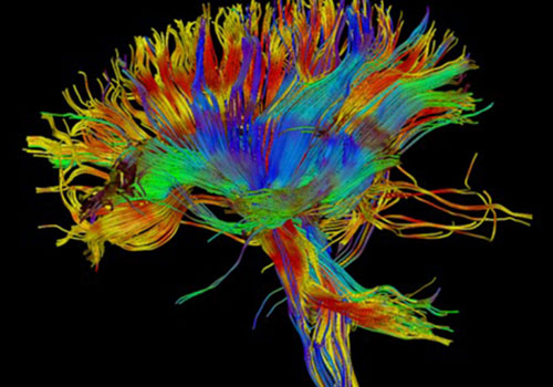 An MRI image of White Matter Fibers in the Brain