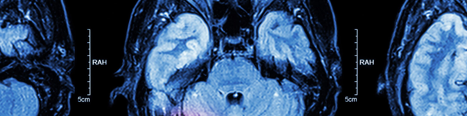 Researching traumatic brain injury in Military personnel